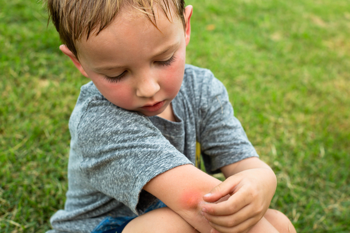 People with mosquitoes bites outdoor. Bug bites in tropical summer.