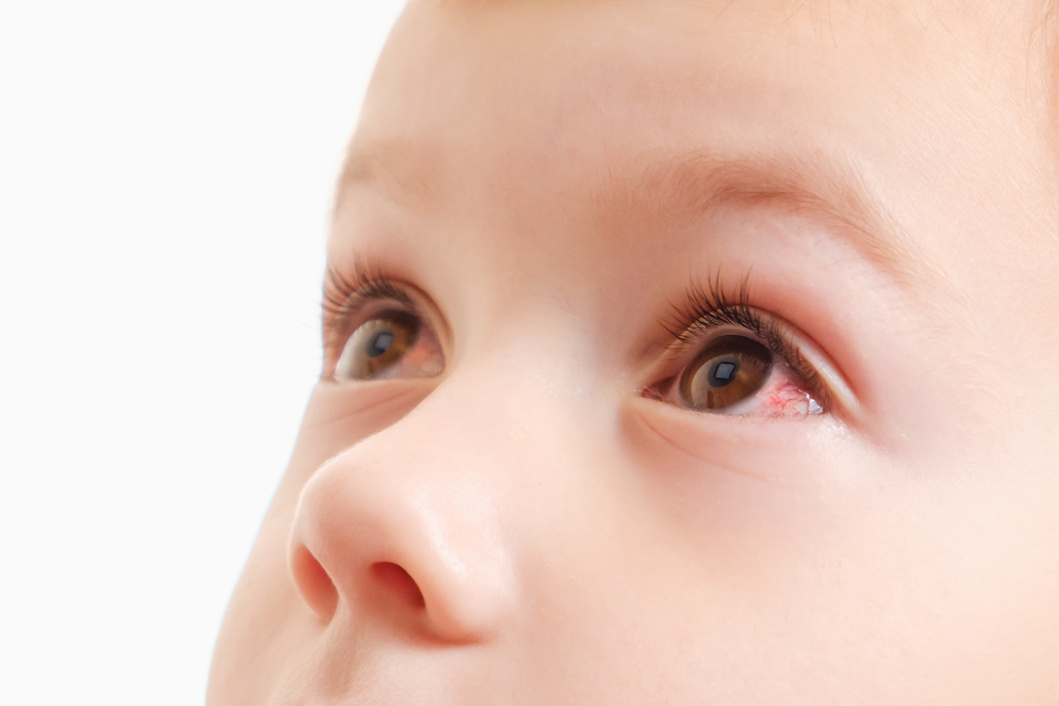 Child conjunctivitis red eye with infection,   illness.